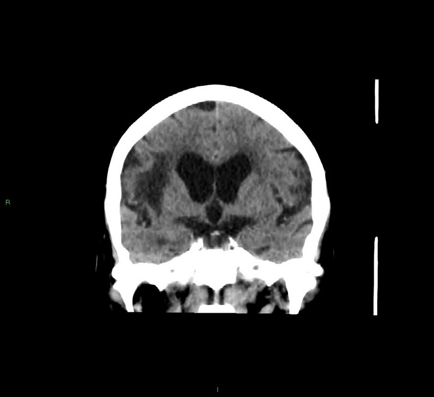 Cerebellar hemorrhage (Radiopaedia 58793-66027 Coronal non-contrast 41).jpg
