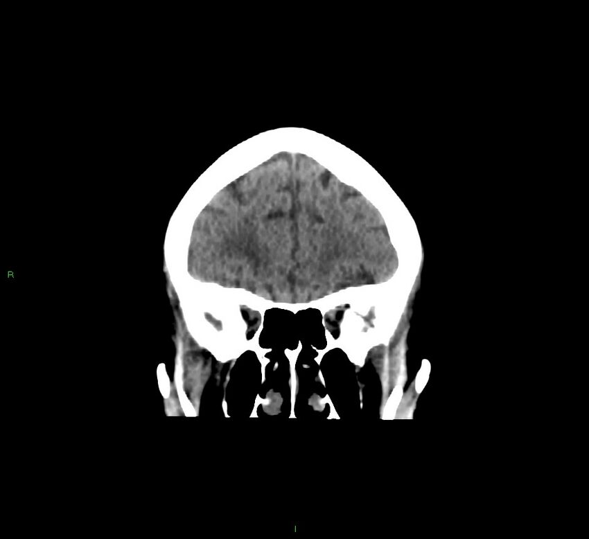 Cerebellar hemorrhage (Radiopaedia 58793-66027 Coronal non-contrast 51).jpg