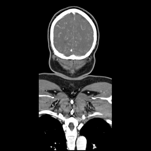 File:Cerebellar infarct due to vertebral artery dissection with posterior fossa decompression (Radiopaedia 82779-97029 D 56).png
