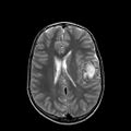 Cerebral abscess post cardiac surgery (Radiopaedia 27244-27420 Axial T2 16).jpg