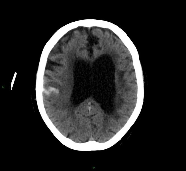 File:Cerebral amyloid angiopathy-associated lobar intracerebral hemorrhage (Radiopaedia 58376-65513 Axial non-contrast 21).jpg