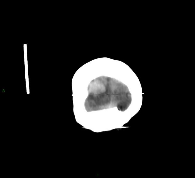 File:Cerebral amyloid angiopathy-associated lobar intracerebral hemorrhage (Radiopaedia 58377-65514 Coronal non-contrast 6).jpg