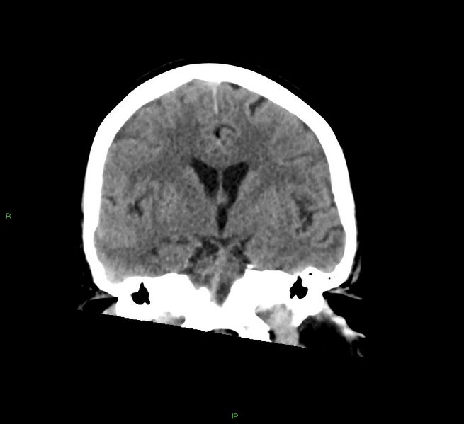 File:Cerebral amyloid angiopathy-associated lobar intracerebral hemorrhage (Radiopaedia 58378-65516 Coronal non-contrast 34).jpg