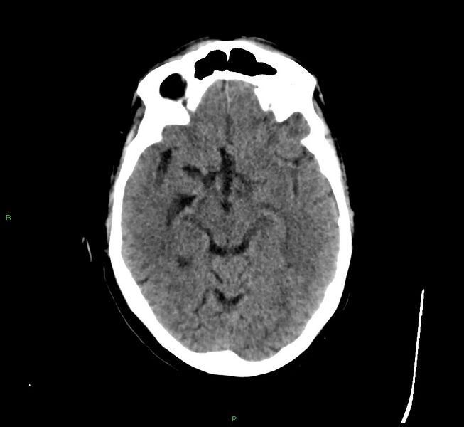 File:Cerebral amyloid angiopathy-associated lobar intracerebral hemorrhage (Radiopaedia 58529-65681 Axial non-contrast 32).jpg