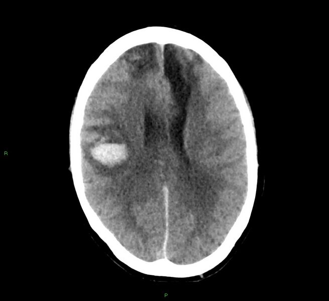 File:Cerebral amyloid angiopathy-associated lobar intracerebral hemorrhage (Radiopaedia 58529-65687 Axial non-contrast 22).jpg