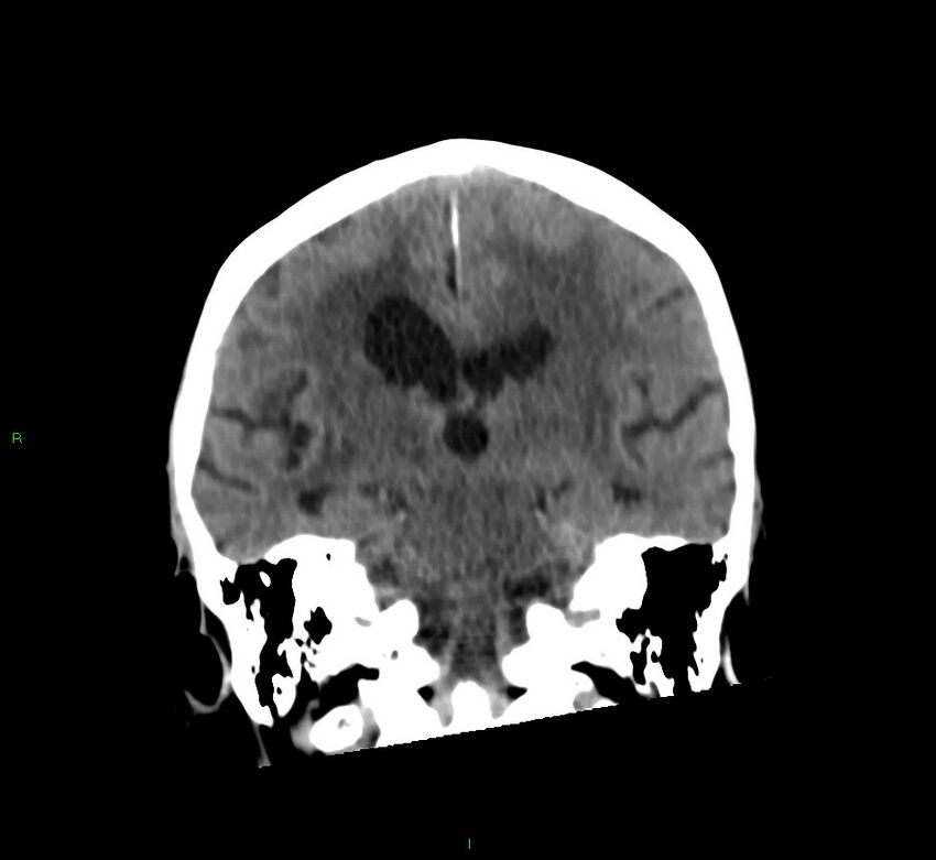 Cerebral amyloid angiopathy-associated lobar intracerebral hemorrhage (Radiopaedia 58530-65688 Coronal non-contrast 32).jpg