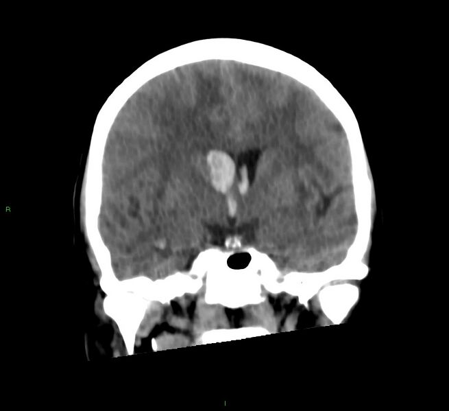 File:Cerebral amyloid angiopathy-associated lobar intracerebral hemorrhage (Radiopaedia 58566-65730 Coronal non-contrast 41).jpg
