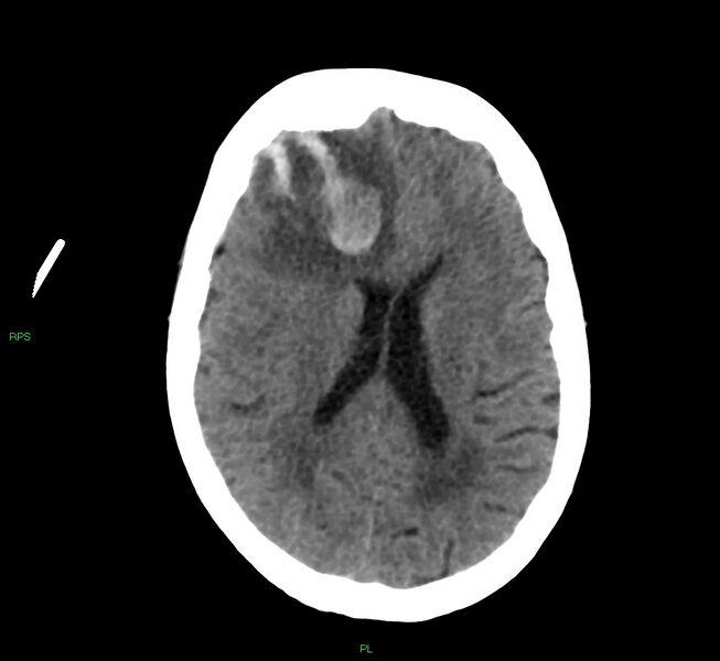 File:Cerebral amyloid angiopathy-associated lobar intracerebral hemorrhage (Radiopaedia 58569-65734 Axial non-contrast 28).jpg