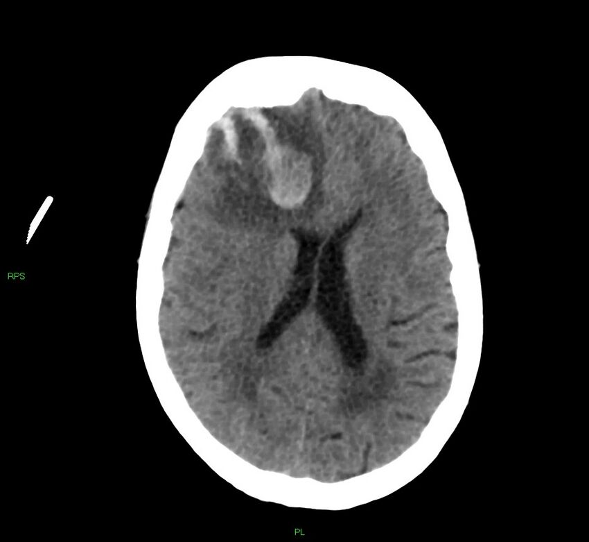 Cerebral amyloid angiopathy-associated lobar intracerebral hemorrhage (Radiopaedia 58569-65734 Axial non-contrast 28).jpg