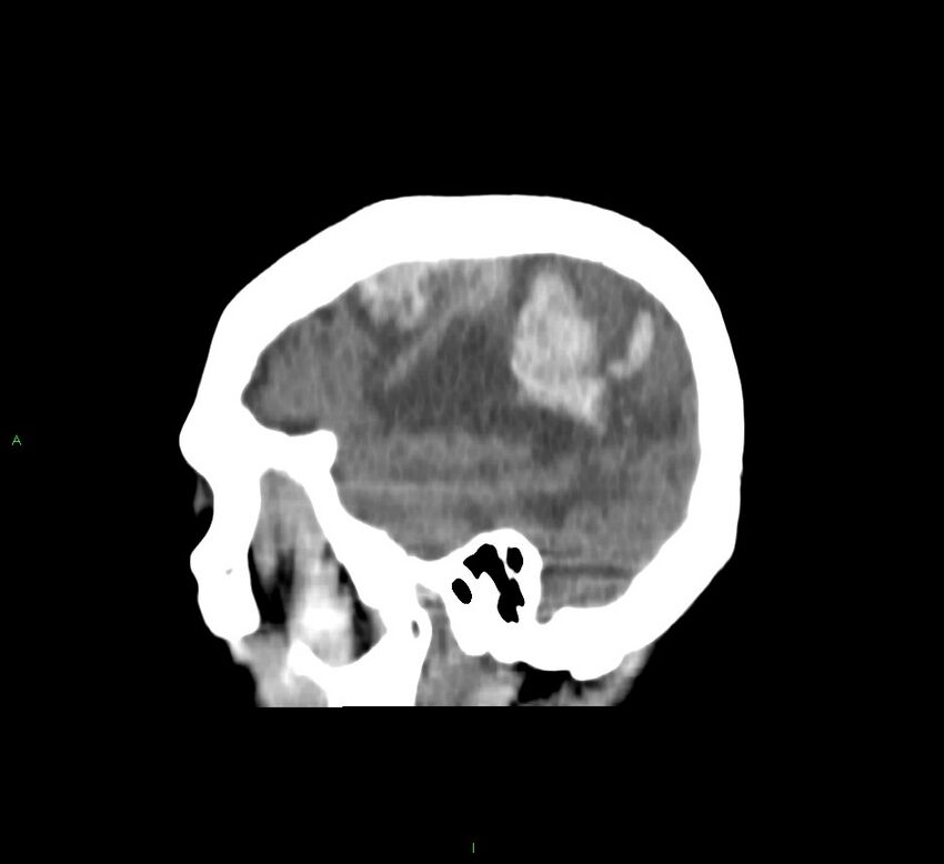 Cerebral amyloid angiopathy-associated lobar intracerebral hemorrhage (Radiopaedia 58751-65972 C 13).jpg