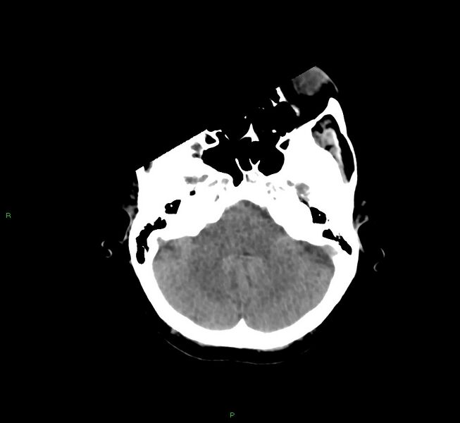 File:Cerebral amyloid angiopathy-associated lobar intracerebral hemorrhage (Radiopaedia 58754-65975 Axial non-contrast 47).jpg