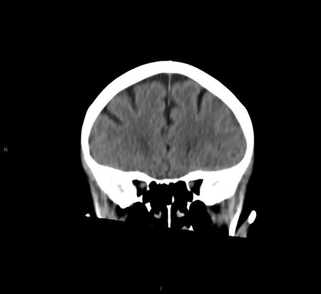 File:Cerebral amyloid angiopathy-associated lobar intracerebral hemorrhage (Radiopaedia 58757-65978 Coronal non-contrast 49).jpg