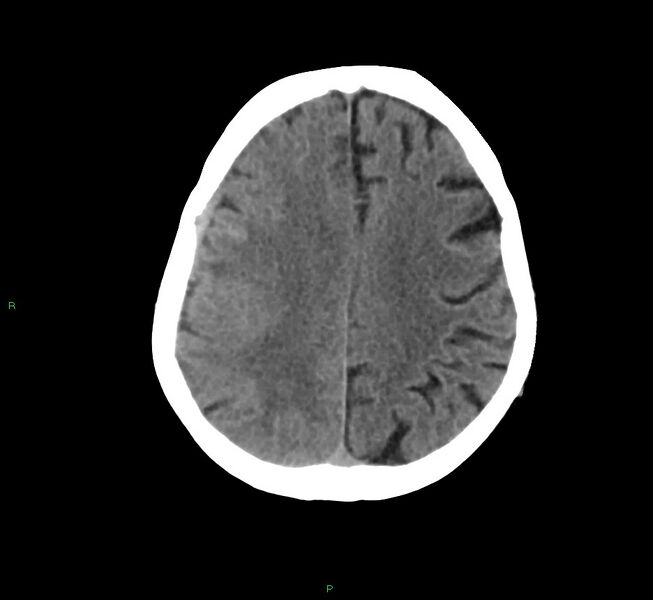 File:Cerebral amyloid angiopathy-associated lobar intracerebral hemorrhage (Radiopaedia 58758-65980 Axial non-contrast 16).jpg