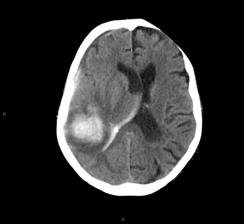 Cerebral amyloid angiopathy-associated lobar intracerebral hemorrhage (Radiopaedia 58758-65980 Axial non-contrast 22).jpg