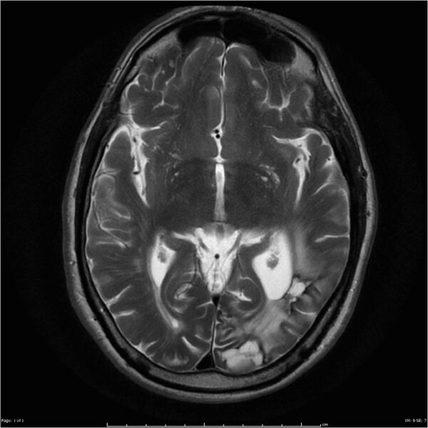 File:Cerebral amyloid angiopathy (Radiopaedia 4561-6683 Axial T2 1).jpg