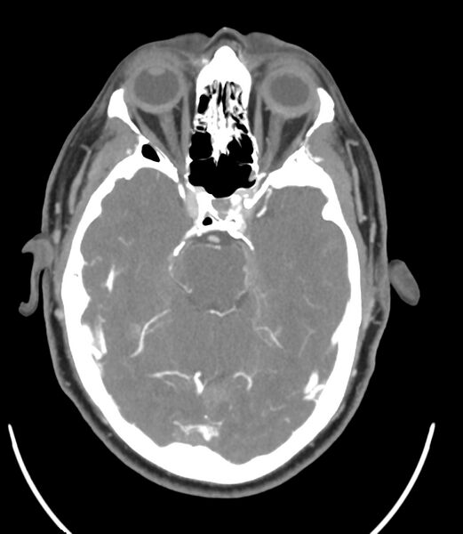 File:Cerebral dural venous sinus thrombosis (Radiopaedia 86514-102576 A 44).jpg