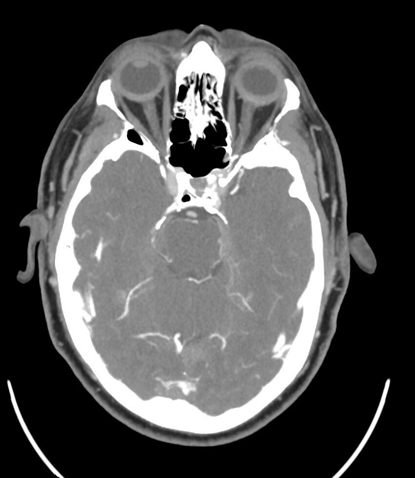 Cerebral dural venous sinus thrombosis (Radiopaedia 86514-102576 A 44).jpg