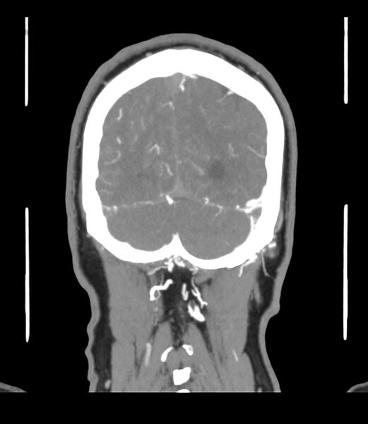 File:Cerebral dural venous sinus thrombosis (Radiopaedia 86514-102576 B 64).jpg