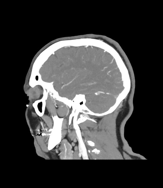 File:Cerebral dural venous sinus thrombosis (Radiopaedia 86514-102576 C 10).jpg
