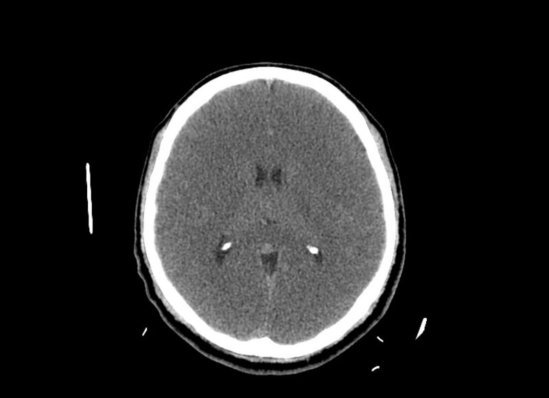 File:Cerebral edema (Radiopaedia 82519-96661 Axial non-contrast 25).jpg