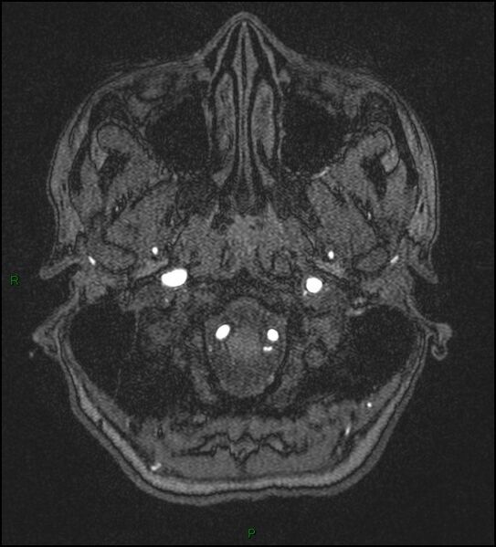 File:Cerebral fat embolism (Radiopaedia 35022-36525 Axial TOF 10).jpg