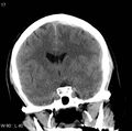Cerebral hemorrhagic contusion with subdural and subarachnoid hemorrhage (Radiopaedia 10680-11146 Coronal non-contrast 9).jpg