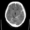 Cerebral hemorrhagic contusions (Radiopaedia 23145-23188 Axial non-contrast 16).jpg