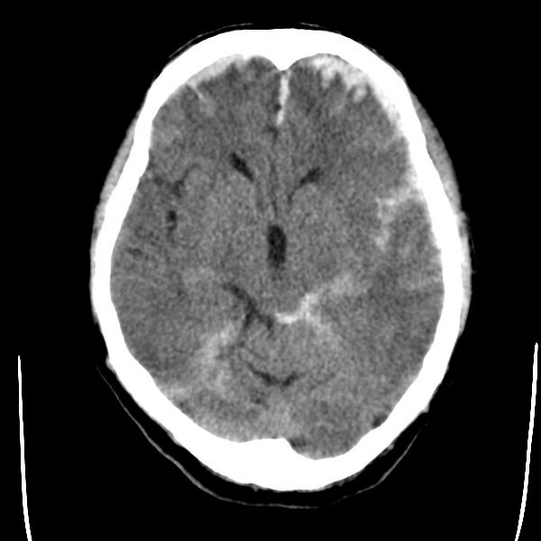 File:Cerebral hemorrhagic contusions (Radiopaedia 23145-23188 Axial non-contrast 16).jpg