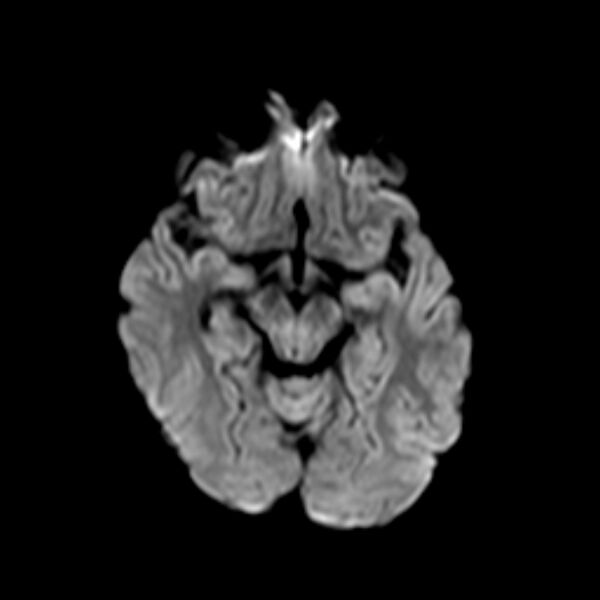 File:Cerebral tuberculoma (Radiopaedia 41152-43932 Axial DWI 8).jpg