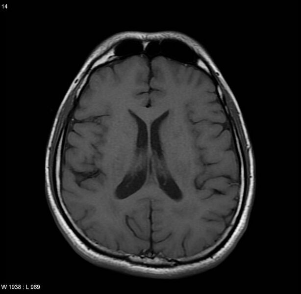File:Cerebral vasculitis (Radiopaedia 5131-6923 Axial T1 1).jpg