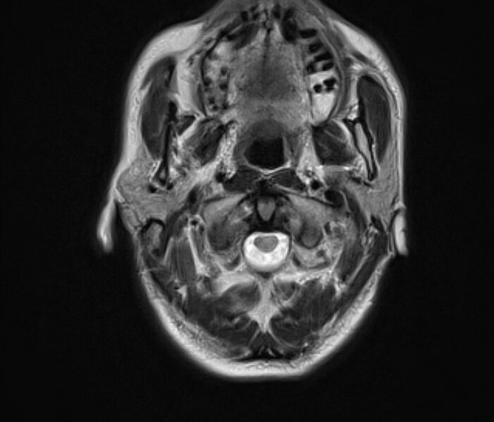 File:Cerebral venous thrombosis (Radiopaedia 71207-81504 Axial T2 2).jpg
