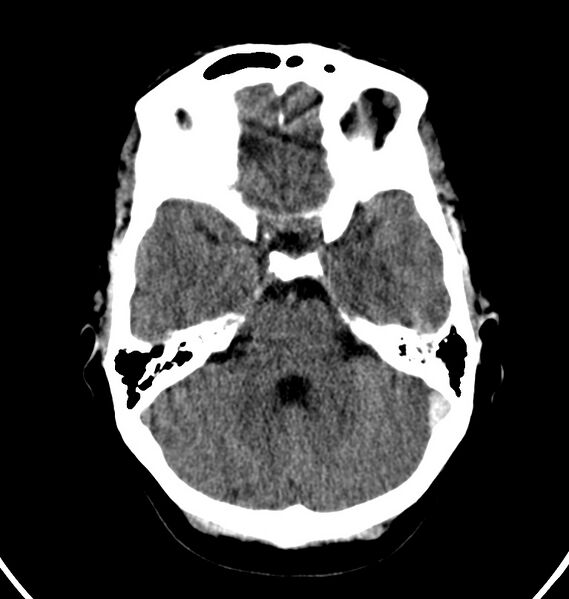 File:Cerebral venous thrombosis - CT only (Radiopaedia 41031-43778 Axial non-contrast 61).jpg