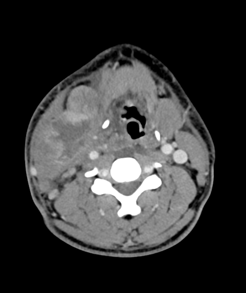 File:Cervical abscess (Radiopaedia 43725-47184 A 36).png