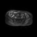 Cervical carcinoma (Radiopaedia 78847-91705 Axial T1 C+ fat sat 2).jpg