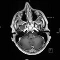 Cervical dural CSF leak on MRI and CT treated by blood patch (Radiopaedia 49748-54995 Axial T1 C+ 24).jpg