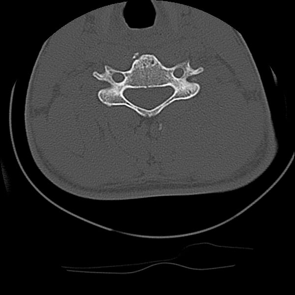 File:Cervical flexion teardrop fracture with cord hemorrhage (Radiopaedia 32497-33454 Axial bone window 51).jpg