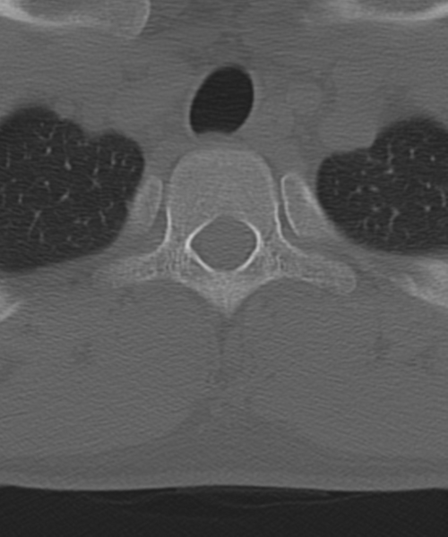 File:Cervical intercalary bone (Radiopaedia 35211-36748 Axial bone window 64).png