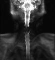 Cervical schwannoma (Radiopaedia 72399-82934 H 1).jpg
