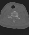 Cervical spine ACDF loosening (Radiopaedia 48998-54071 Axial bone window 41).png