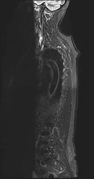 File:Cervical tumor-like myelopathy due to Type V dAVF (Radiopaedia 82461-96604 B 17).jpg