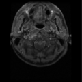 Cervical vertebrae metastasis (Radiopaedia 78814-91667 Axial T1 C+ fat sat 14).png