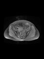 Cesarean section scar endometrioma (Radiopaedia 56569-63297 Axial PD fat sat 16).jpg