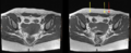 Cesarian scar endometriosis (Radiopaedia 68495-78306 A 4).png