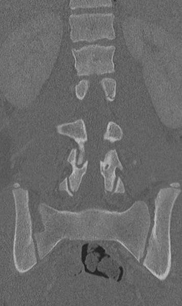 File:Chance fracture (Radiopaedia 40360-42912 Coronal bone window 39).png