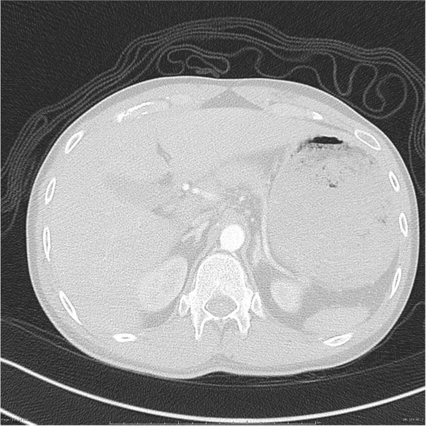Chest and abdomen multi-trauma (Radiopaedia 26294-26425 lung window 104).jpg