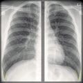 Chest x-ray - breathing (Radiopaedia 32556-33507 E 1).jpg