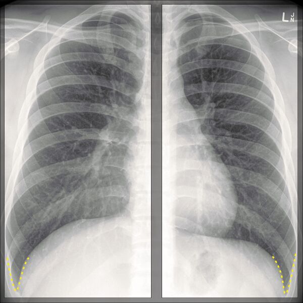 File:Chest x-ray - breathing (Radiopaedia 32556-33507 E 1).jpg
