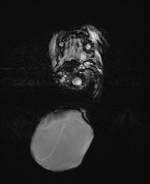 File:Chiari III malformation with occipital encephalocele (Radiopaedia 79446-92559 Axial SWI 15).jpg