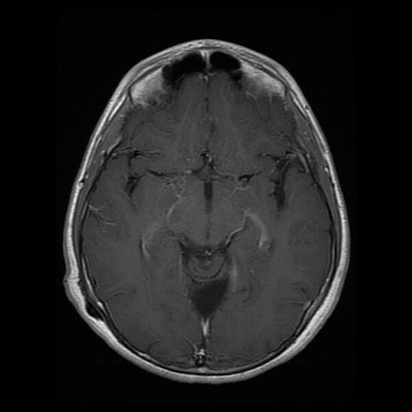 File:Chiasmatic-hypothalamic juvenile pilocytic astrocytoma (Radiopaedia 78533-91236 Axial T1 C+ 14).jpg