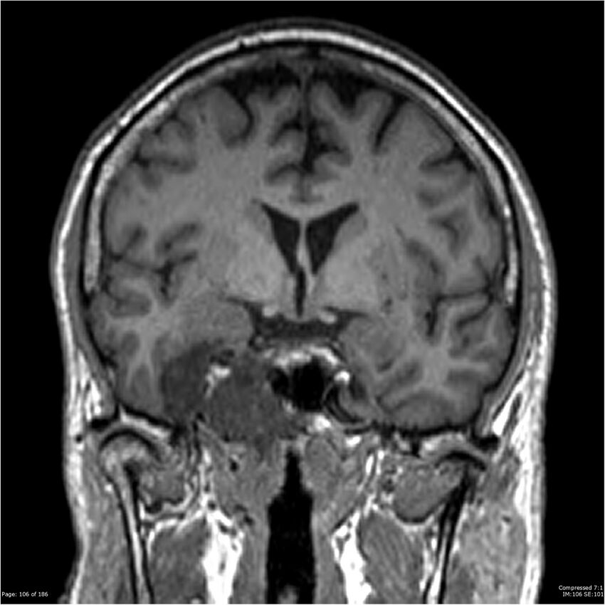 Chondrosarcoma of skull base- grade II (Radiopaedia 40948-43654 Coronal T1 27).jpg